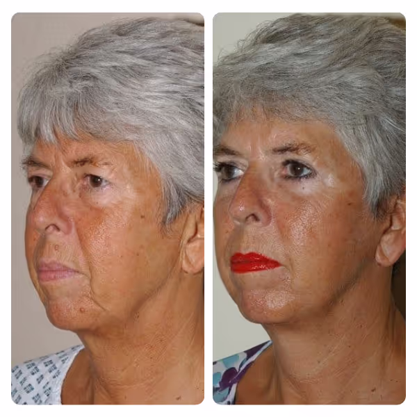 Neck Lift in Turkey